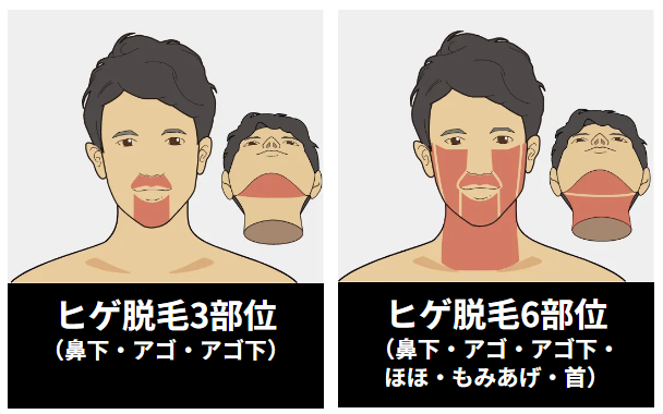 ヒゲ脱毛3部位、ヒゲ脱毛6部位