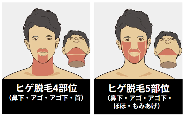 ヒゲ脱毛4部位、ヒゲ脱毛5部位